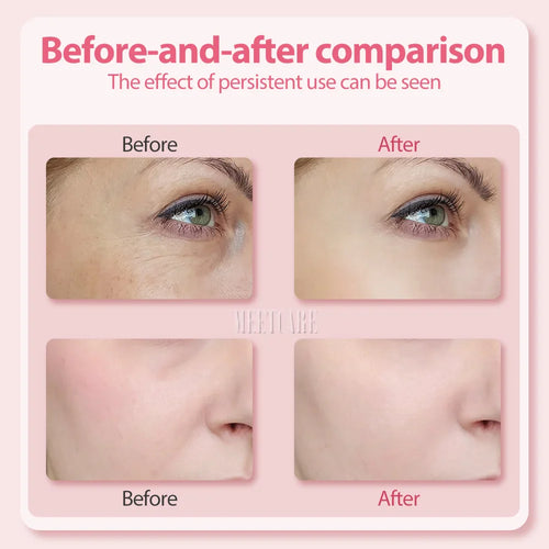 Light Therapy Facial Wand